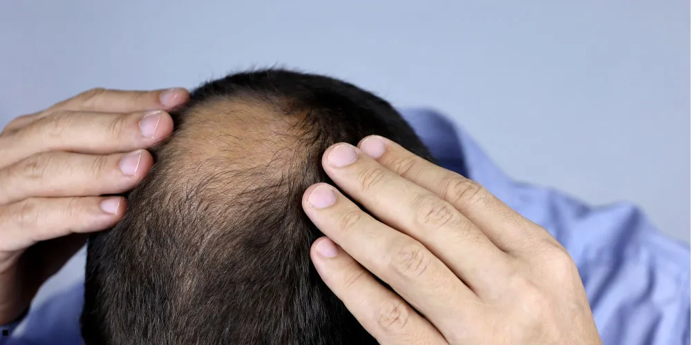 SAÇ DÖKÜLMESİNDE GİZLİ NEDEN: VİTAMİN VE MİNERAL EKSİKLİĞİ