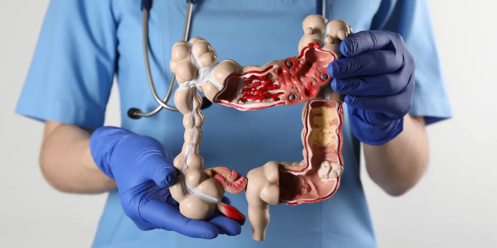 KOLON KANSERİ VAKALARINDA ARTIŞ: ERKEN TEŞHİS HAYAT KURTARIYOR